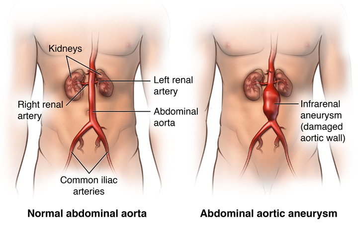 Abdominal Aortic Aneurysm | Living Smart | St. Joseph's/Candler | St  Josephs / Candler