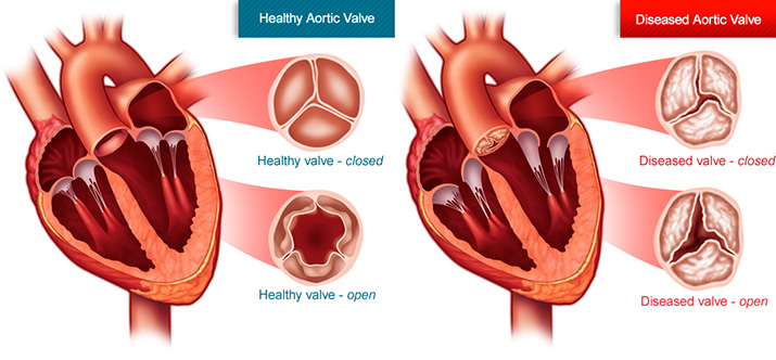 What is aortic stenosis St. Joseph s Candler St Josephs Candler