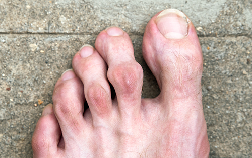 What causes hammertoes and corns?