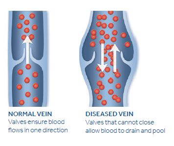 7 Ways to Prevent Varicose Veins From Getting Worse · Conway Medical Center