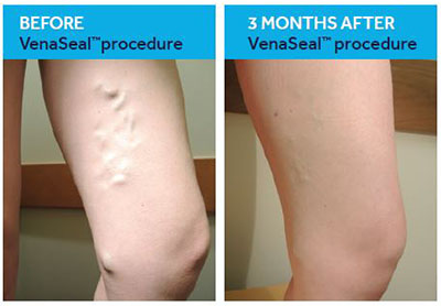 Varicose Veins Treatment Options in Tomball: Heart & Vascular